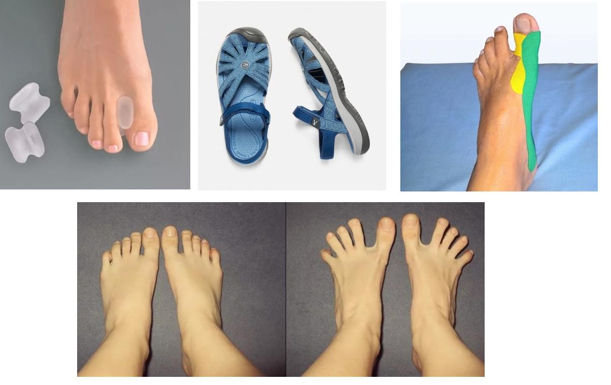 Косточка на большом пальце ноги: незначительный дефект или серьезная проблема